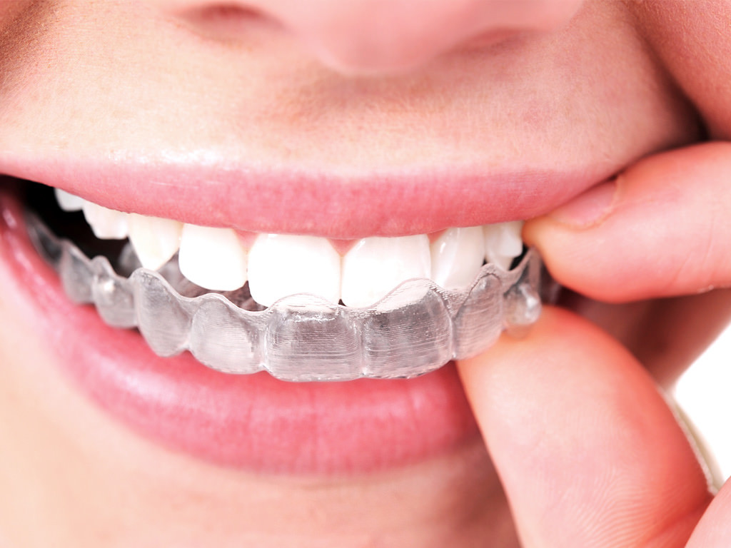 New Orthodontic Options For People Everywhere: SmileDirectClub