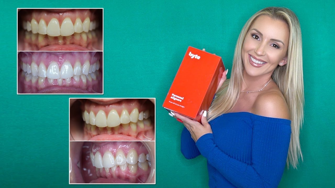 Byte Review: Is Byte The Better Option To Straighten Your Teeth ...